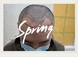 -大麦微针植发全国连锁