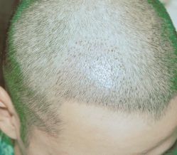 -大麦微针植发丨全国连锁