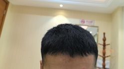 -碧莲盛·不剃发植发