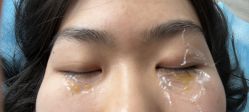 -爱莎扁平疣·汗管瘤·斑痣中心