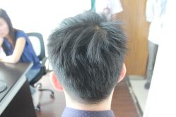 点击看大图 -大麦微针植发丨全国连锁