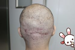 点击看大图 -大麦微针植发丨全国连锁