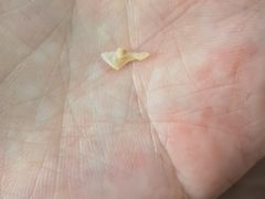 -祖传修脚甲沟炎灰指甲鸡眼
