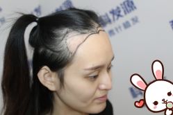 -大麦微针植发丨全国连锁