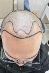 -大麦微针植发全国连锁