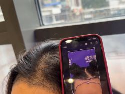 -碧莲盛·不剃发植发