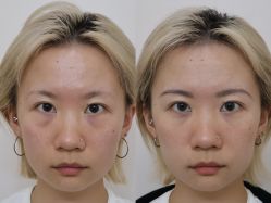 -广州健丽·去眼袋医疗美容机构