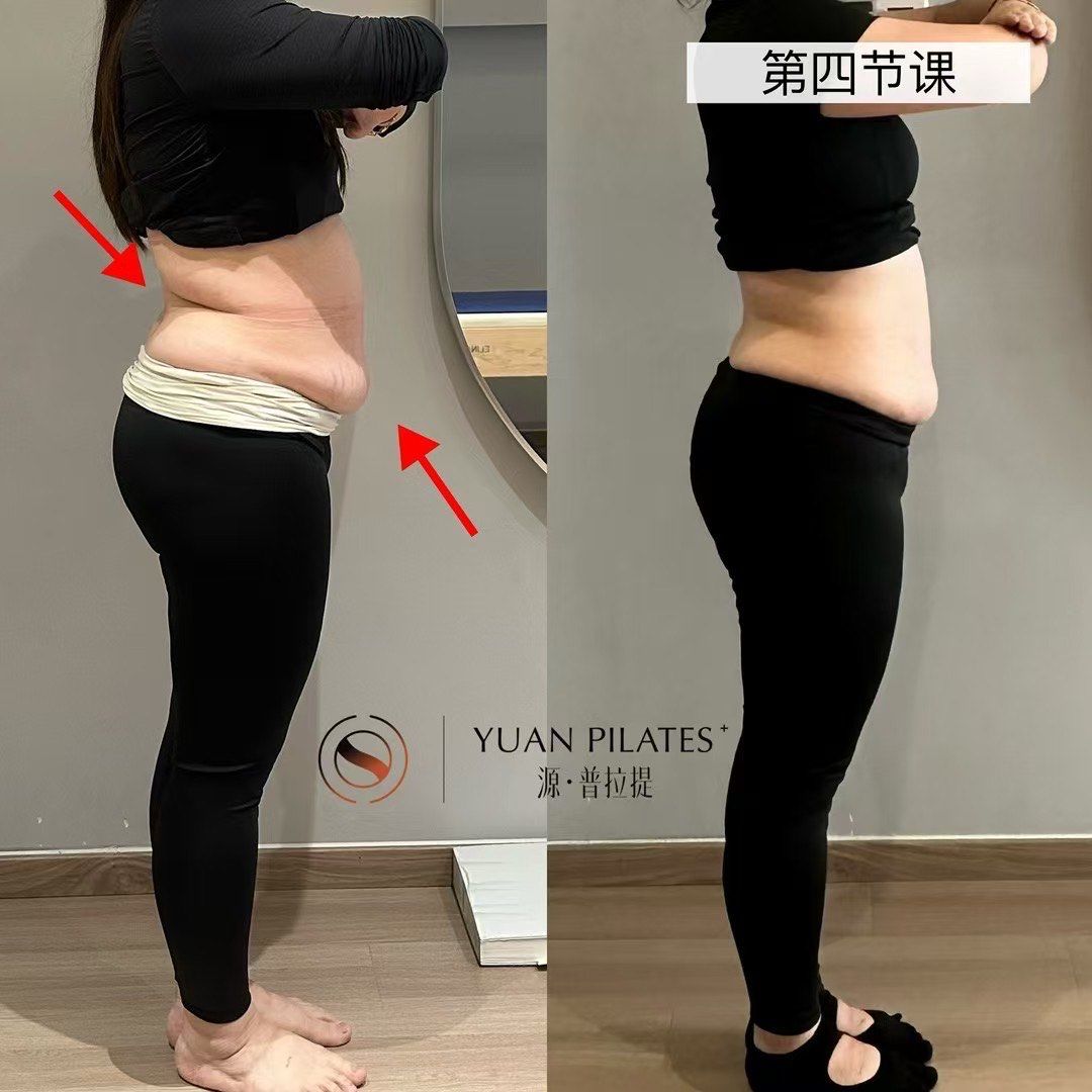 产后悬垂腹解决方案