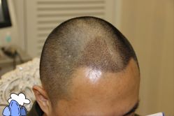 -大麦微针植发丨全国连锁