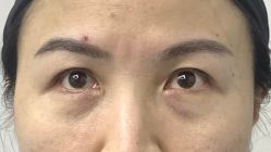 -广州健丽·去眼袋医疗美容机构