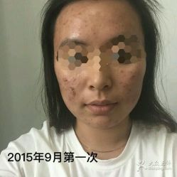 -苗方清颜专业祛痘