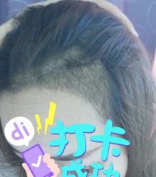 -大麦微针植发全国连锁