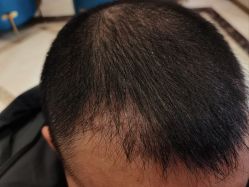 -碧莲盛·不剃发植发