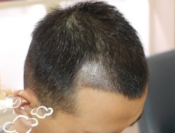 -大麦微针植发丨全国连锁