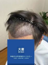 -大麦微针植发全国连锁