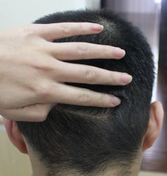 -大麦微针植发丨全国连锁