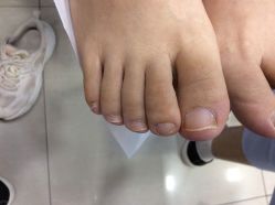 -德哥灰指甲脚气甲沟炎跖疣护理