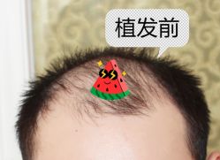 -大麦微针植发全国连锁