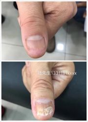-德哥灰指甲脚气甲沟炎跖疣护理