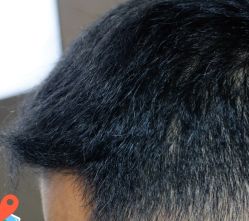 -大麦微针植发丨全国连锁