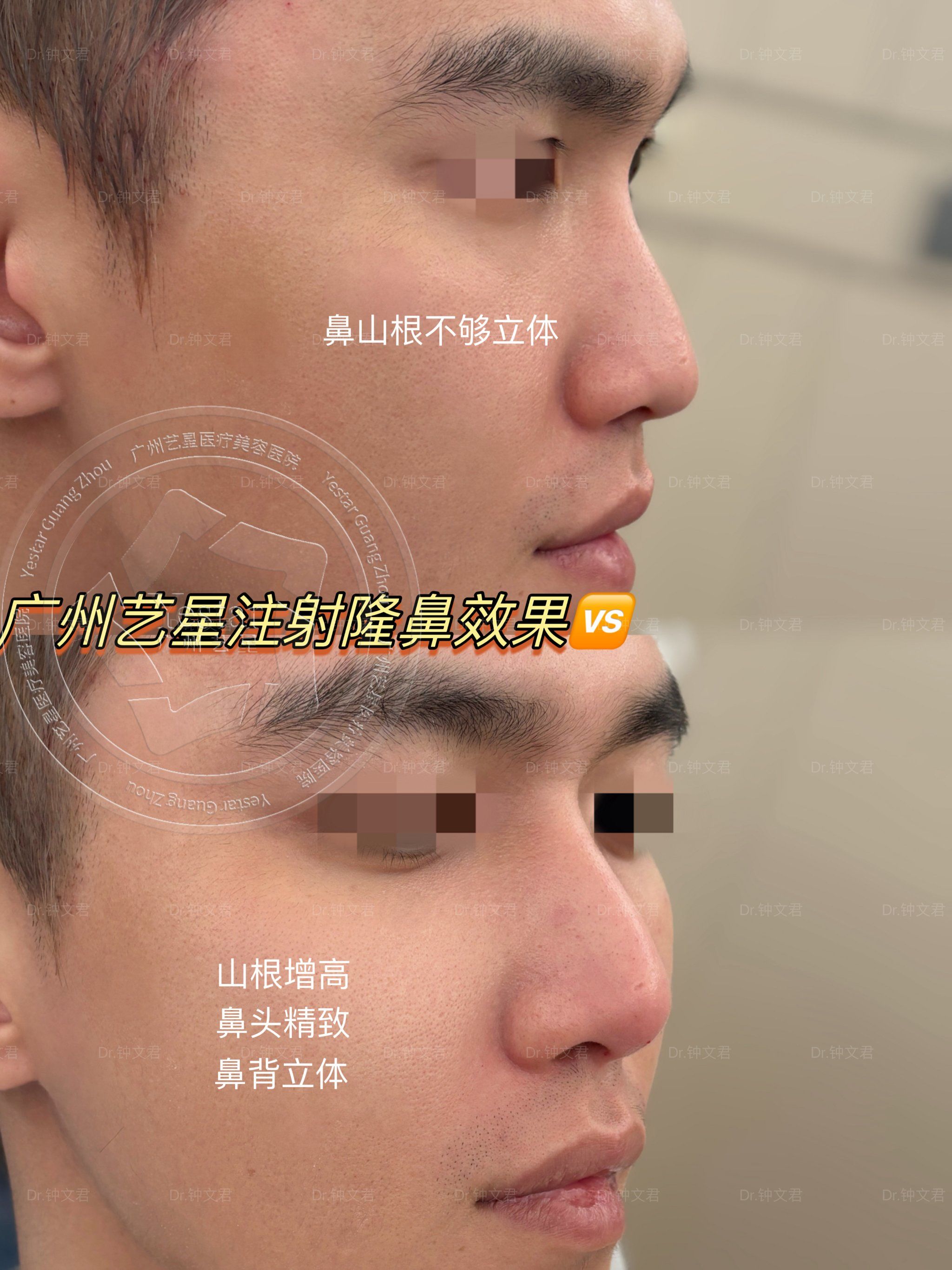 n
这位男宝鼻山根不够立体,鼻头圆钝,鼻背低,因为害怕动刀,选择