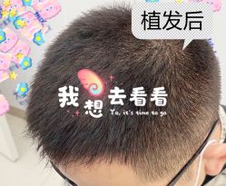 -大麦微针植发全国连锁