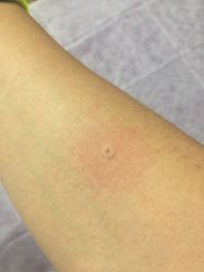 -痣清宫祛斑祛痣连锁店