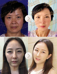 V美减龄案例-加减美医美连锁品牌