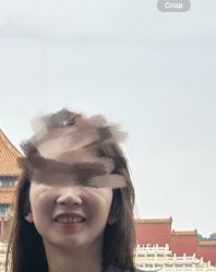 点击看大图 体验后-北京英煌医疗美容