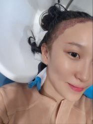 -大麦微针植发全国连锁