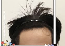 -大麦微针植发全国连锁