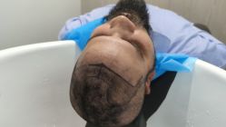 -大麦微针植发全国连锁