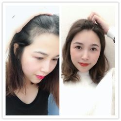 -大麦微针植发全国连锁