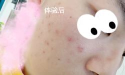 体验后-慕颜医疗美容·皮肤微整 抗衰