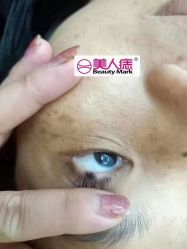 -美人痣全国连锁