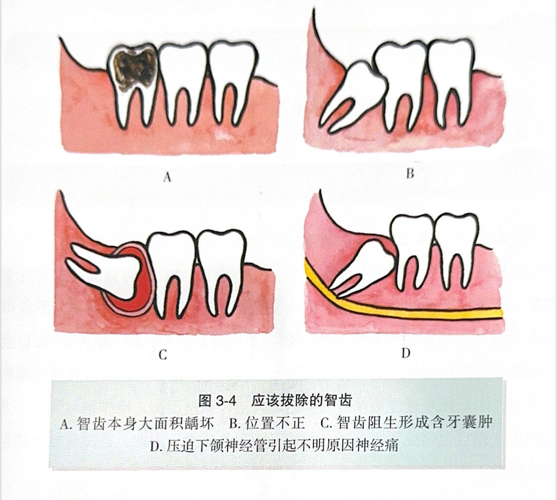 n
如果智齿完全萌出,位置很正,有正常的咬合关系,能行使正常的