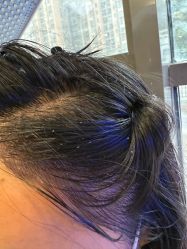 -碧莲盛·不剃发植发