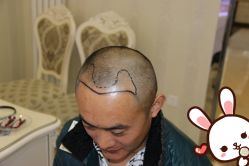 点击看大图 -大麦微针植发丨全国连锁