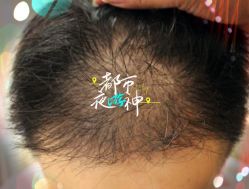 -大麦微针植发全国连锁