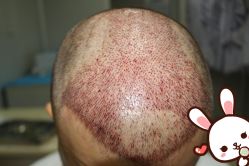 点击看大图 -大麦微针植发丨全国连锁