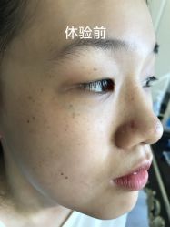 -美丽人生祛斑扁平疣汗管瘤中心