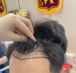 -碧莲盛·不剃发植发