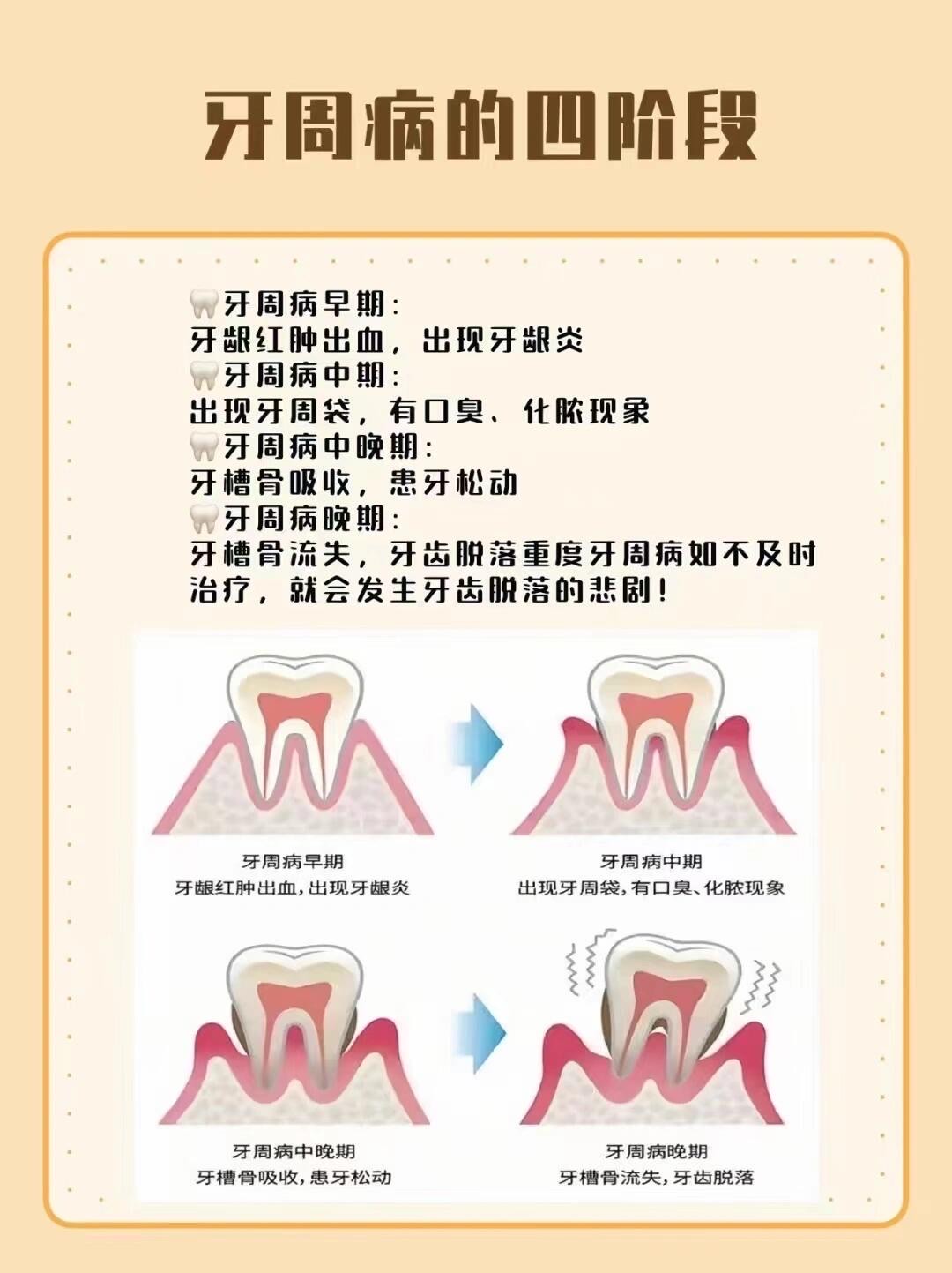 牙周病刮治的流程图片图片