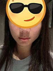 体验后-针美汇欧邦医疗美容