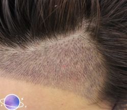 -大麦微针植发丨全国连锁