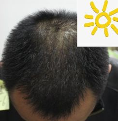 -大麦微针植发丨全国连锁