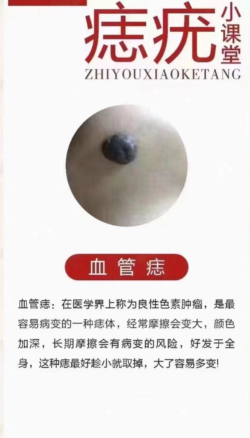 家人们身上有痣   瘊的要注意了751575157515