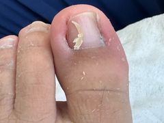 -世龙世家灰指甲鸡眼脚气甲沟炎跖疣护理(通州店)