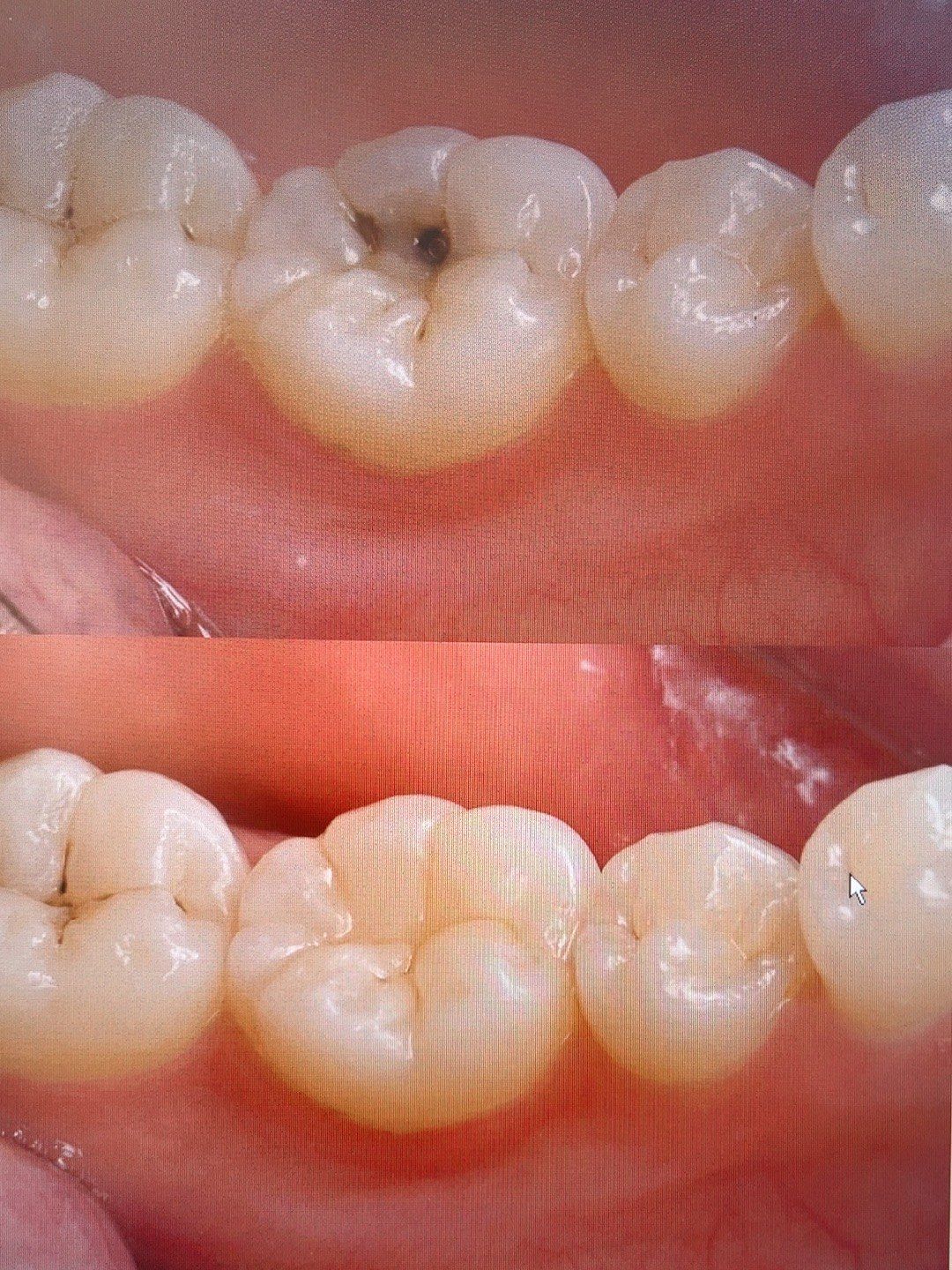 n真的是一次让自己非常满意的补牙之旅
自己之前也是有蛀牙的泅况