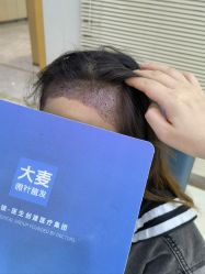-大麦微针植发丨全国连锁